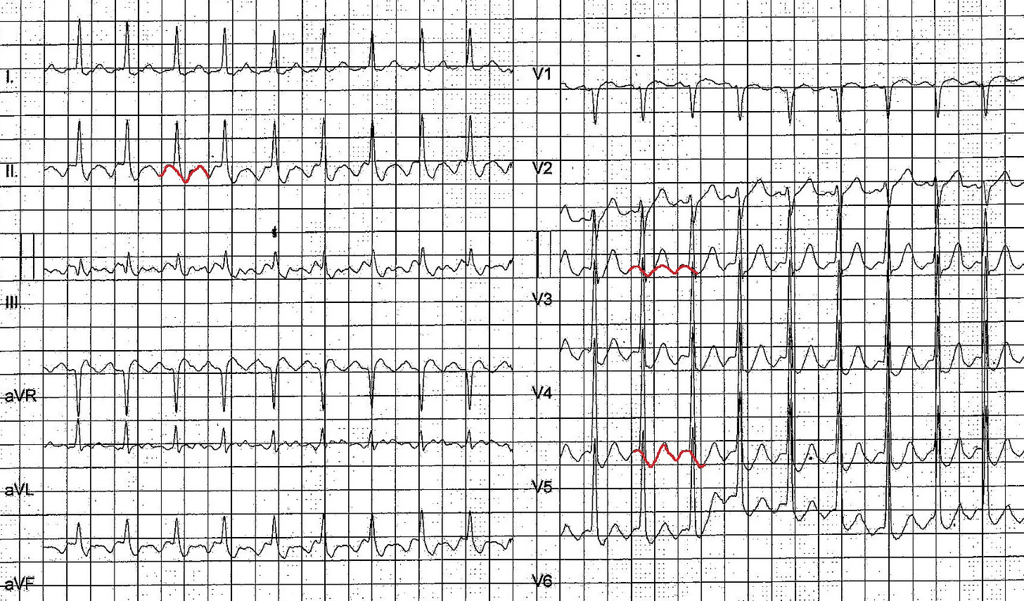 Atrial flutter with 2:1 AV conduction ratio Atrial flutter with 2:1 AV conduction ratio