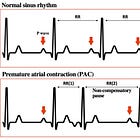 Premature complexes: atrial vs junctional vs ventricular