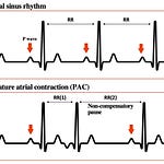 QRS complex nomenclature and morphology