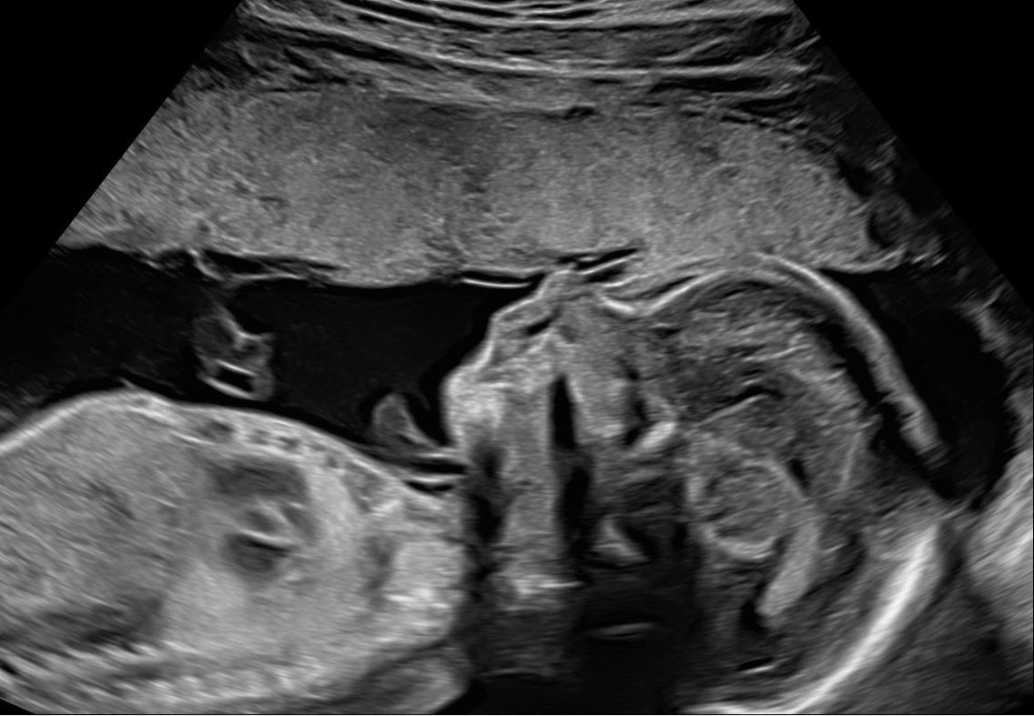 Fetal ultrasound