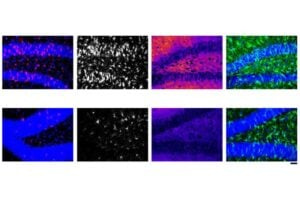 In the brain's immune cells, called microglia, the gene product PU.1 is associated with excessive inflammation in neurological disorders such as Alzheimer's disease. MIT researchers delivered a small interfering RNA (siRNA) via lipid nanoparticles to reduce expression of PU.1 in mice. Microglia stained for PU.1 or related markers are less evident in the bottom row, which reflects the effects of the siRNA, compared to an experimental control (top row).