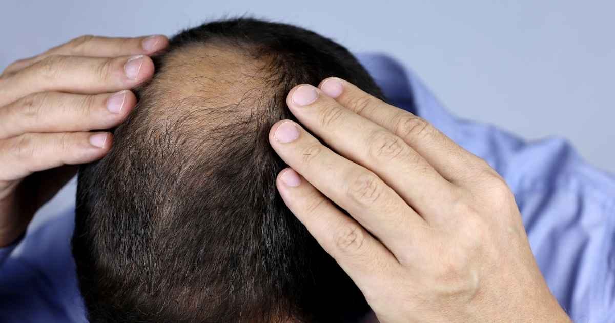 male hands on balding head