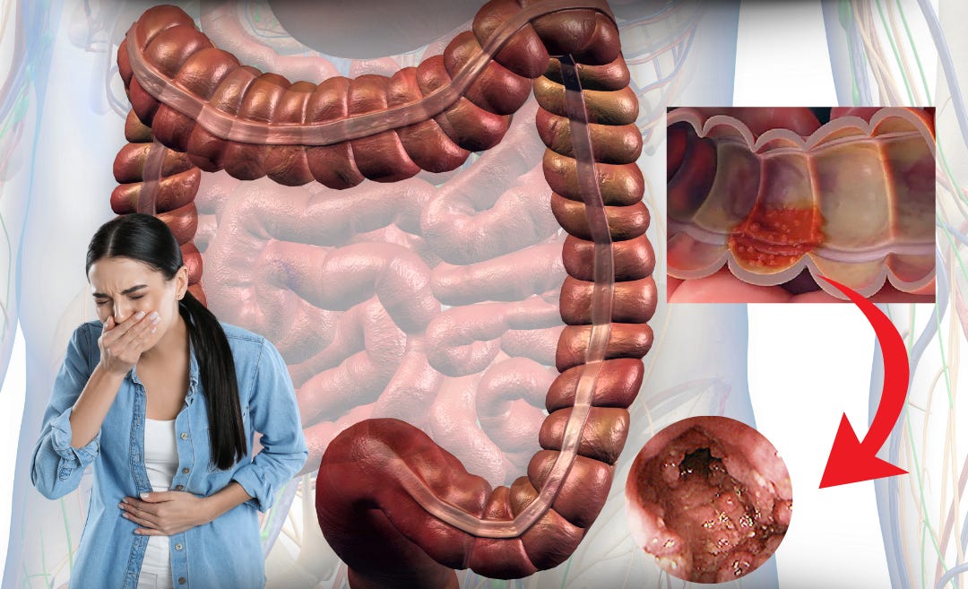 Colite ulcerativa: o que é, sintomas, causas e tratamento