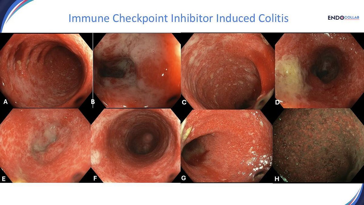 Immune Checkpoint Inhibitor Induced Colitis or “Immune Mediated Colitis”