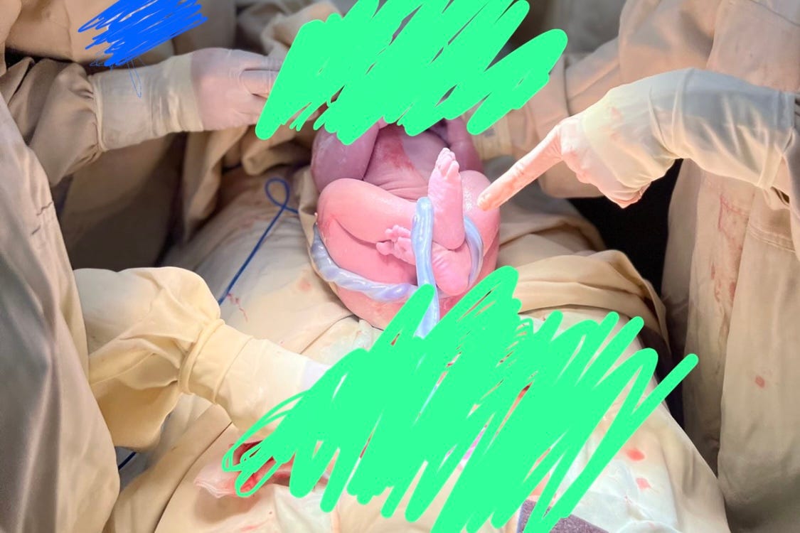 doctors standing around a c-section patient as the chief surgeon points to the umbilical cord, which is wrapped around the baby's feet and hip