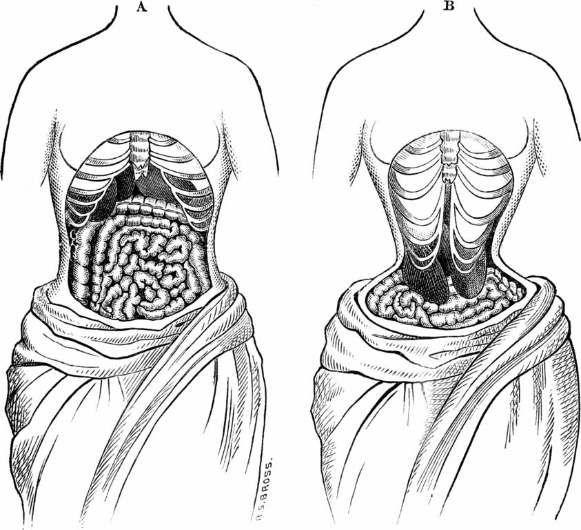 From ″Physiology for Young People″ p. 84. Fig. 11.A purports to show the natural position of internal organs. B, when deformed by tight lacing of a corset. In this way the liver and the stomach have been forced downward, as seen in the cut. (Public domain image via wikimedia commons.)