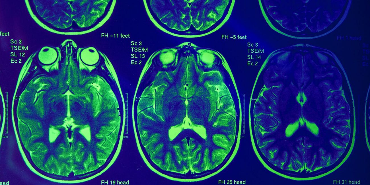 Autoimmune Brain Inflammation with 'Psychiatric Manifestations' Following Pfizer COVID-19 Injection: New Case Report in 'Archives of Clinical Neuropsychology'