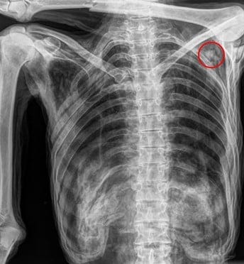 Advanced Imaging Discovers Oldest Human Blood Cells Preserved in Iceman | Imaging Technology News Advanced Imaging Discovers Oldest Human Blood Cells Preserved in Iceman | Imaging Technology News