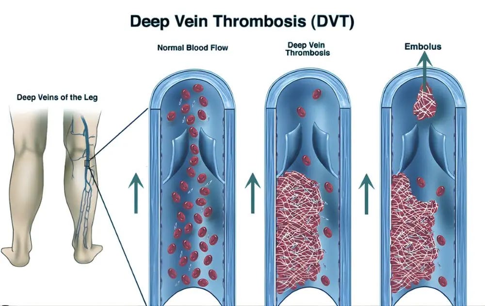 Deep Vein Thrombosis (DVT): Causes, Symptoms &amp; Prevention