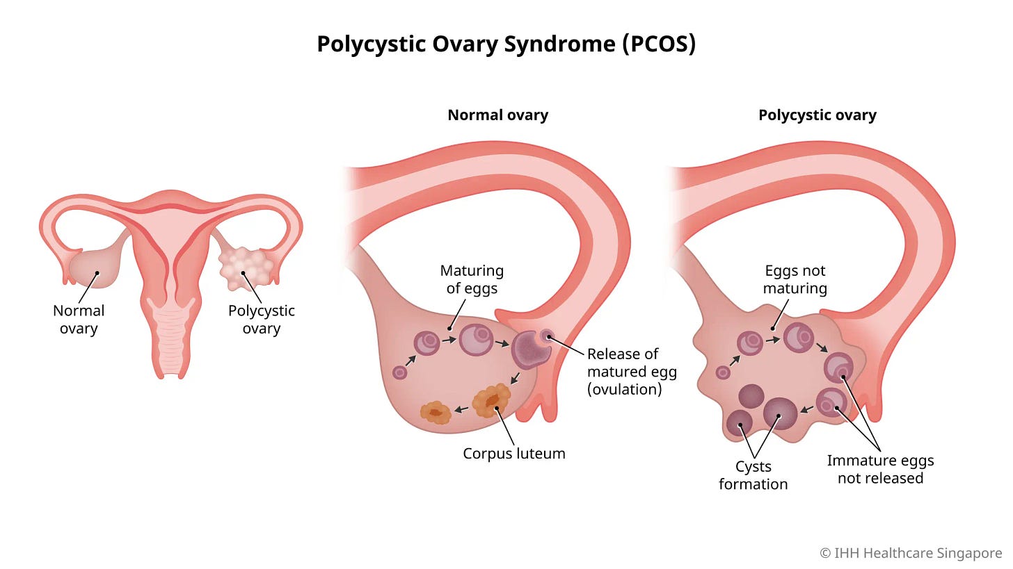 Polycystic Ovary Syndrome (PCOS) - Causes, Symptoms & Signs | Gleneagles  Hospital