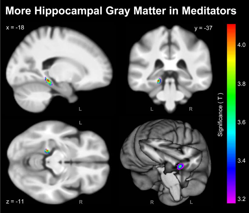 Frontiers | Meditation effects within the hippocampal complex revealed by  voxel-based morphometry and cytoarchitectonic probabilistic mapping