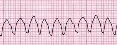Ventricular tachycardia - Wikipedia