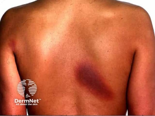 DermNet image of Fixed Drug Eruption example on back DermNet image of Fixed Drug Eruption example on back