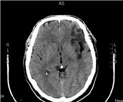 Ischemic stroke in frontal lobe (computed tomogra- phy) in a patient... |  Download Scientific Diagram
