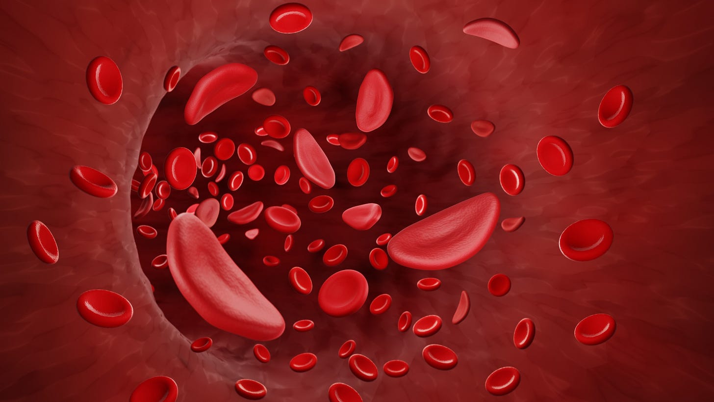 New Curative Treatment for Sickle Cell Disease New Curative Treatment for Sickle Cell Disease