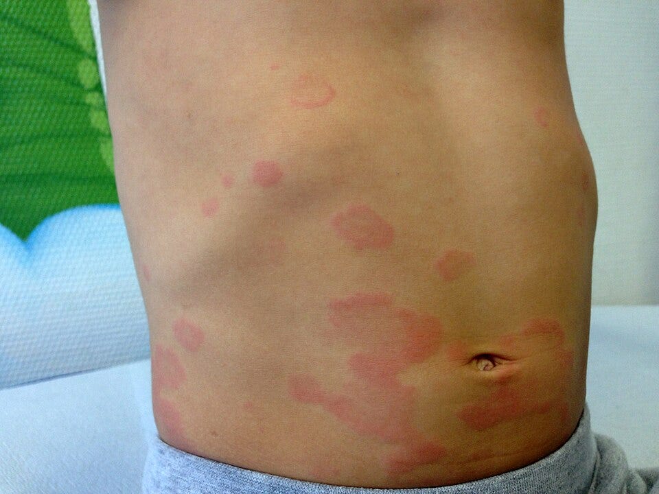 File:Urticaria child.jpg