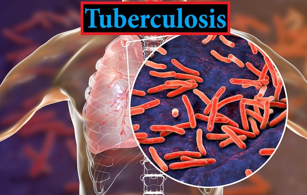 Διαψεύδοντας τη Λοιμώδη Αιτιολογία της Φυματίωσης