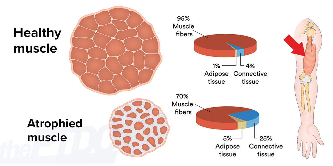 How to Fight Muscle Atrophy After Injury: A Personal Trainer's Guide