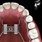 Palate expanders are completely wrong