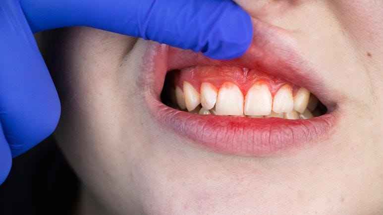 gum disease mental health