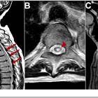 SARS-CoV-2 and LNP-mRNA platform induced neurological pathologies and associated autoimmune antibodies