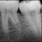 Do these biomechanics cause 'root resorption'? 