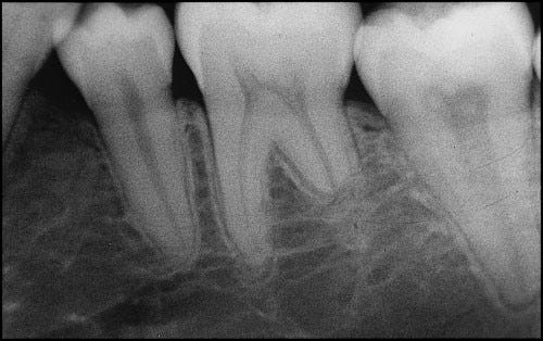 Radiographic diagnosis of root resorption in relation to orthodontics |  British Dental Journal