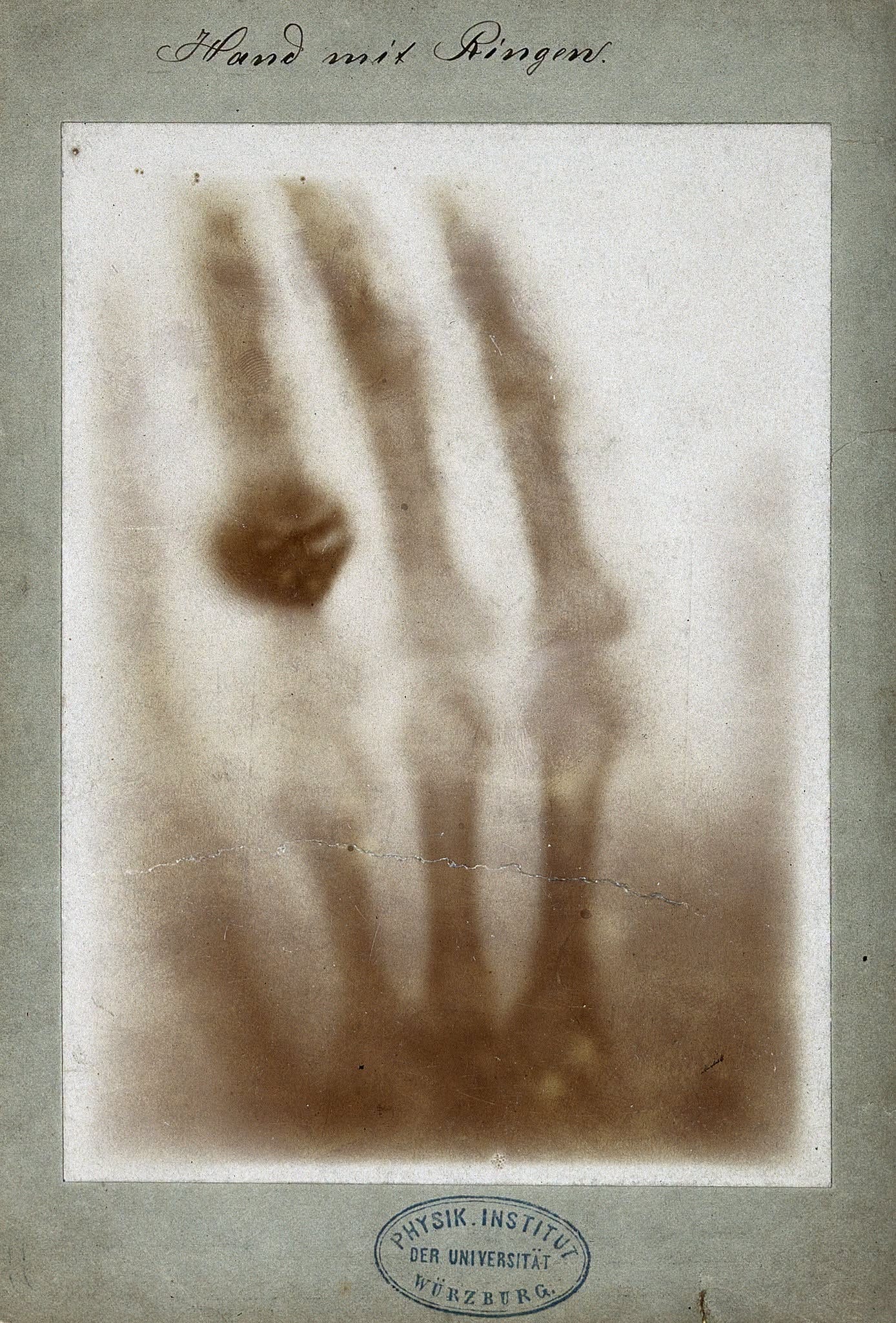 X-ray photograph of Bertha Röntgen’s hand, showing the bones of her fingers and palm beneath the soft tissue, with two dark rings on one finger. X-ray photograph of Bertha Röntgen’s hand, showing the bones of her fingers and palm beneath the soft tissue, with two dark rings on one finger.