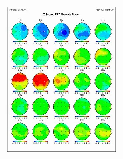 Quantitative EEG | Sinha Clinic | Call us to Schedule a Brain Map!