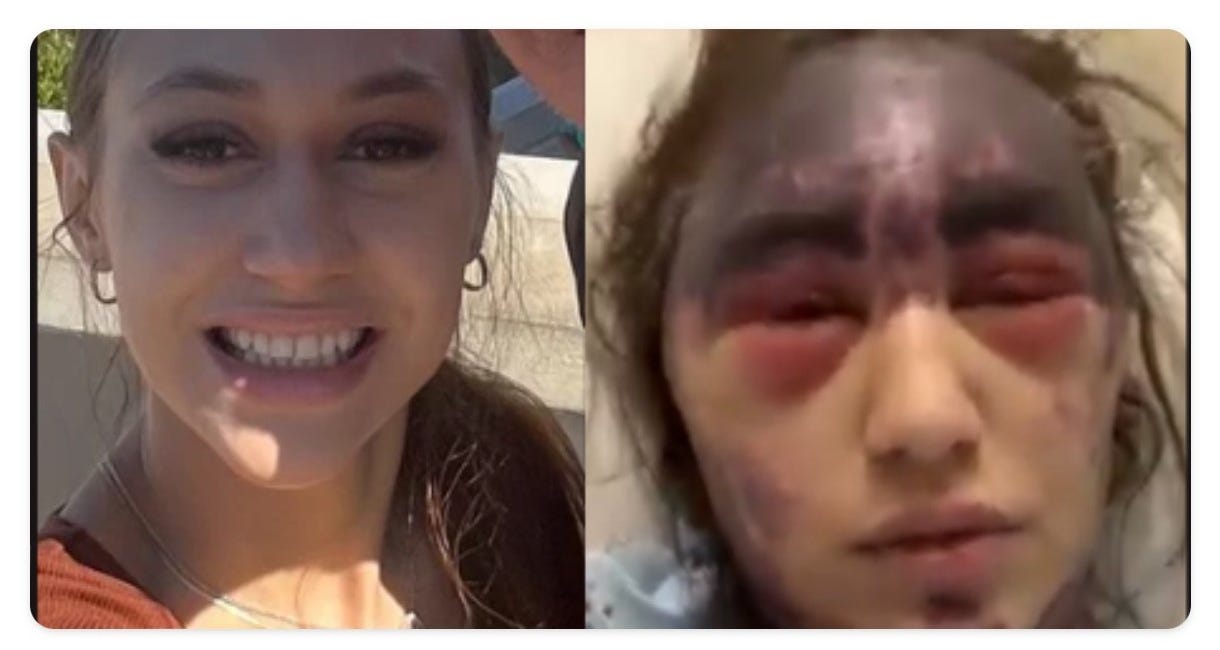 Alexis Lorenze Update