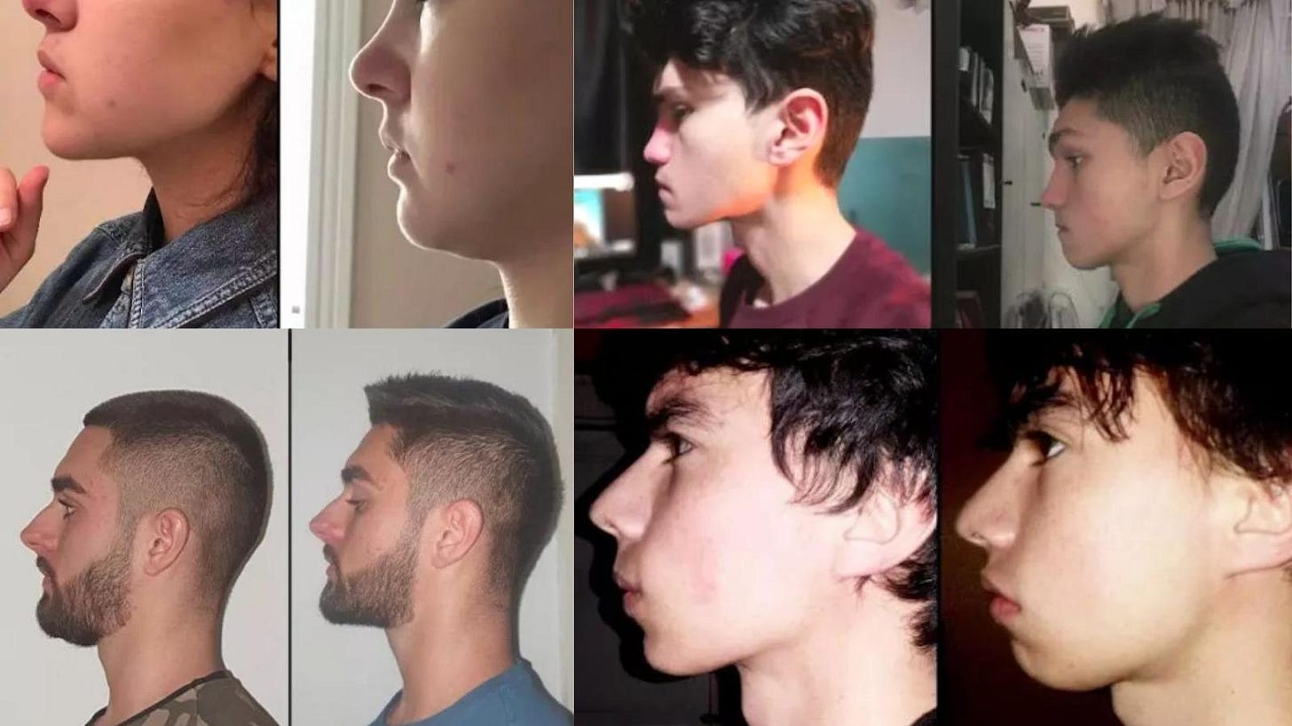 3 Effective Transformation: Mewing Before And After – Jawliner USA