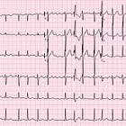 Ashman phenomenon | ECG challenge #5
