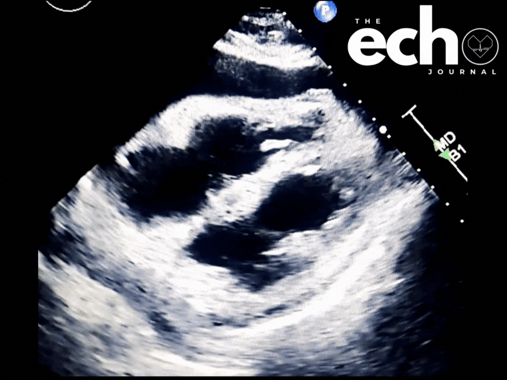 You Found an Effusion, Now What? Echo Recognition of Tamponade
