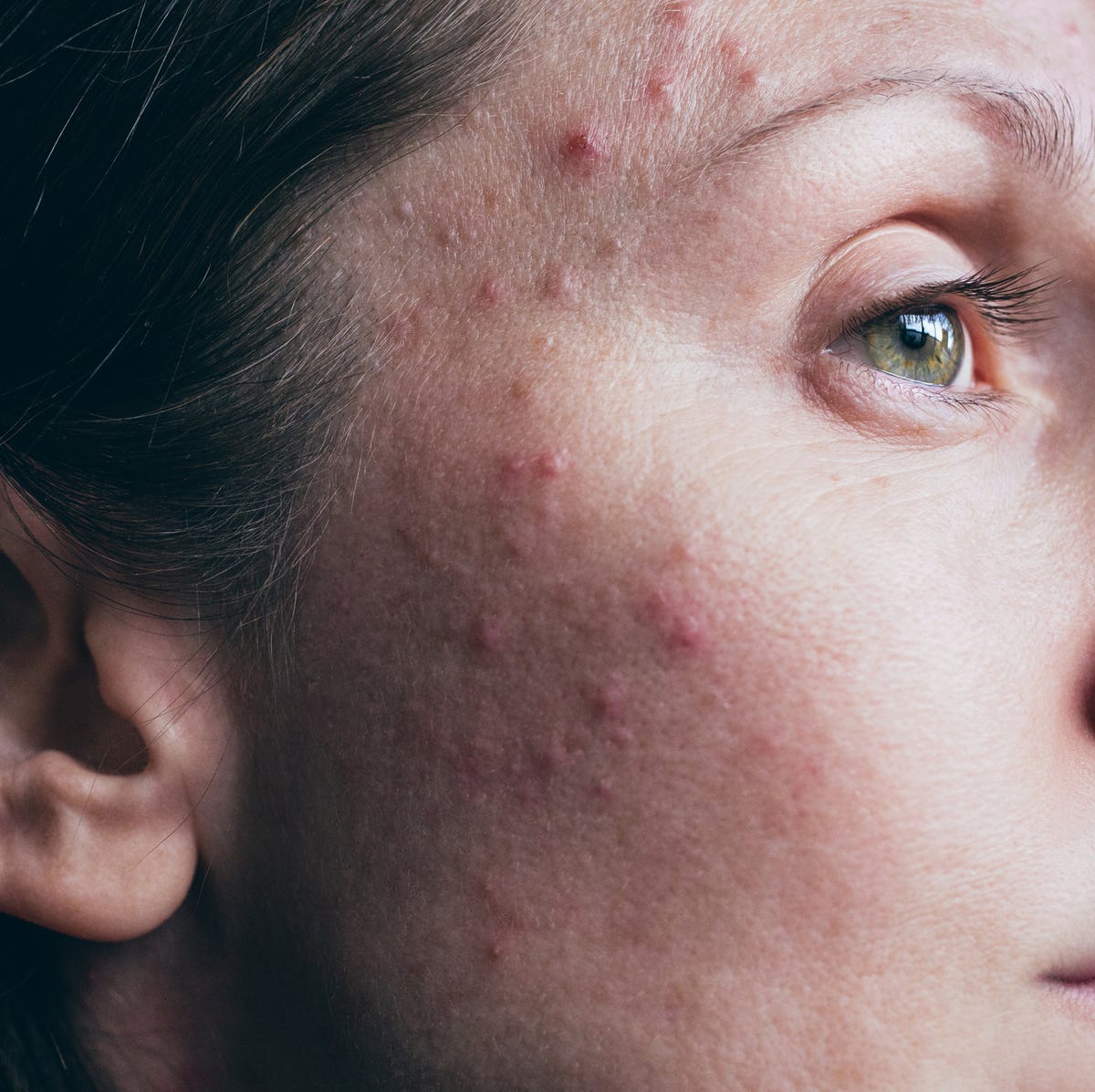 What Is Skin Purging? Experts Explain Causes And Treatments What Is Skin Purging? Experts Explain Causes And Treatments