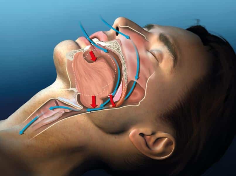 Airway Dentistry - Lake Forest Smiles