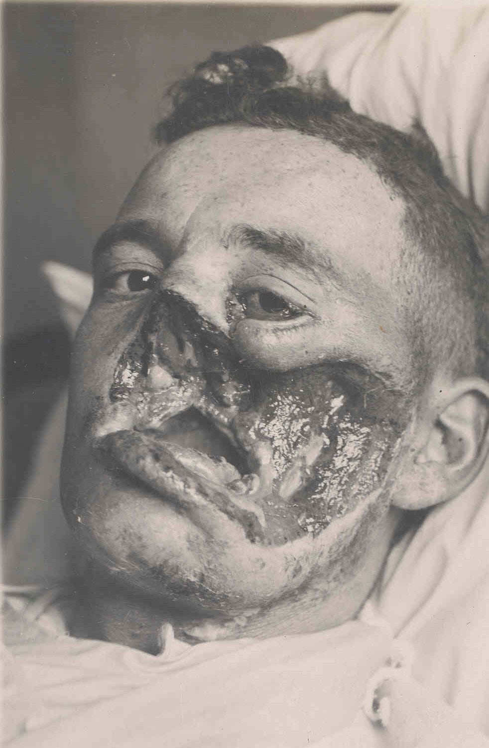 Soldiers With Broken Faces: Graphic Photos Behind The Origins Of Plastic Surgery On WW1 Casualties Soldiers With Broken Faces: Graphic Photos Behind The Origins Of Plastic Surgery On WW1 Casualties
