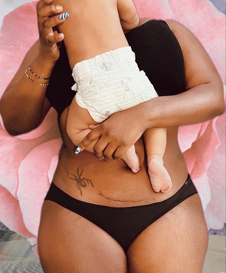 This contains: Black mothers with c section scars