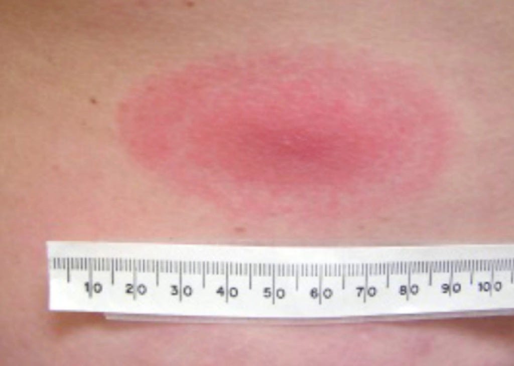 Lyme disease - description - by Will Taylor