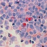 Fenbendazole & Cancer