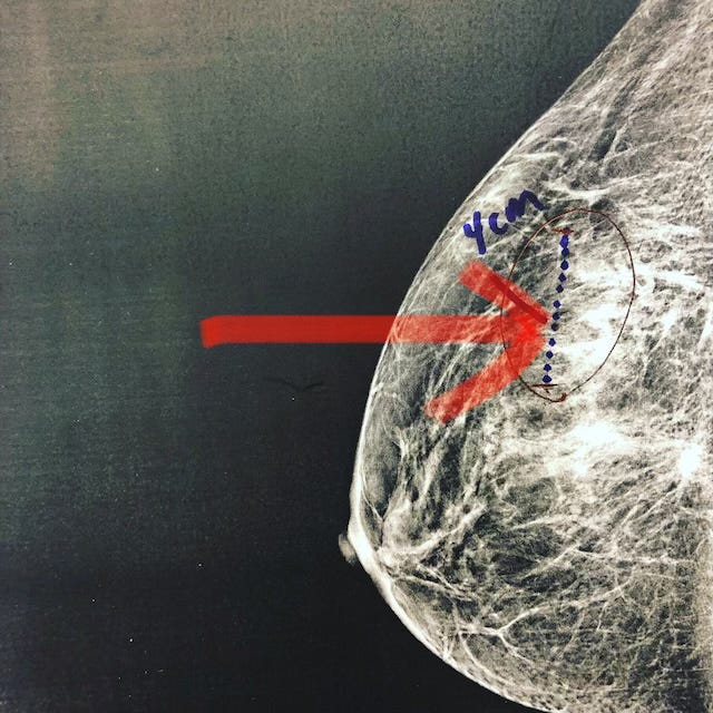 What It's Like to Find Out You Have Cancer, Part 3