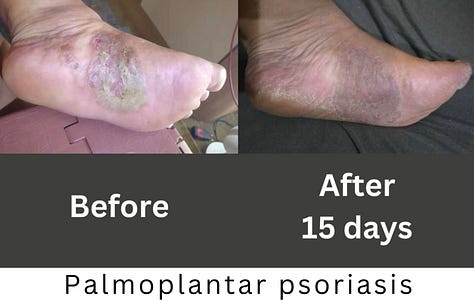 Podocon Application Rash CDS Topical Protocol for Treating Skin Issues
