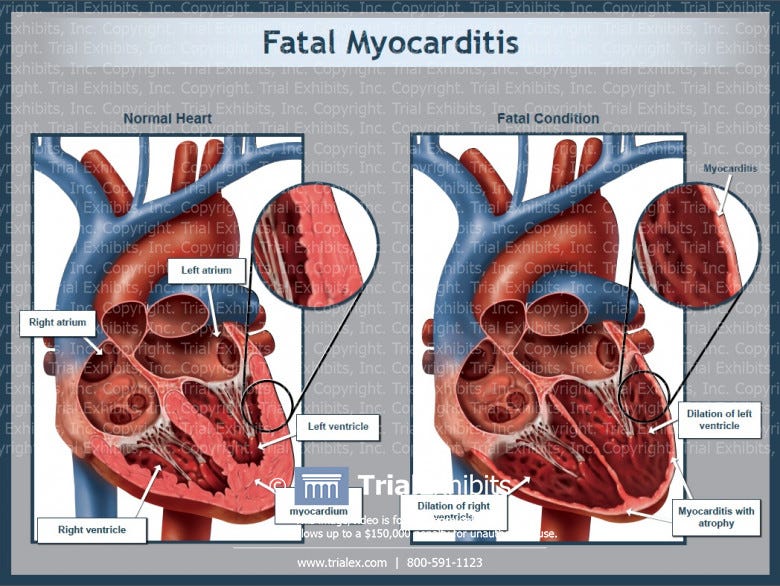 Fatal Myocarditis Fatal Myocarditis
