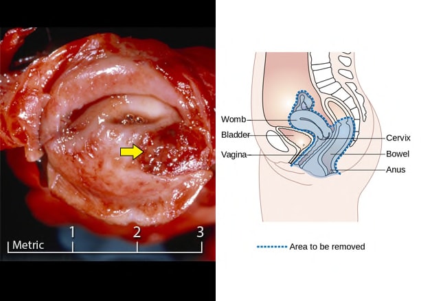 Cervical Cancer: Screening, Recognition, and Treatment