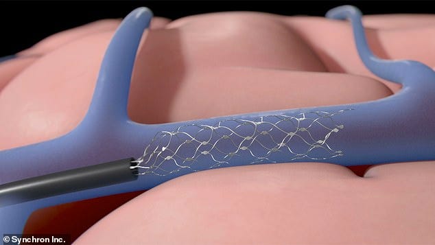 Once implanted in a blood vessel that sits over the motor cortex, Stentrode expands to press the electrodes against the vessel wall close to the brain where it can record neural signals Once implanted in a blood vessel that sits over the motor cortex, Stentrode expands to press the electrodes against the vessel wall close to the brain where it can record neural signals