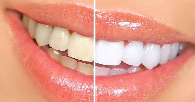 Clareamento dental em Santo André - Rubi Odonto