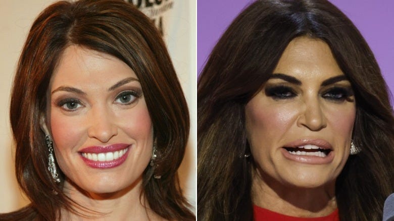 What Exactly Is Mar-A-Lago Face And Who Has Clearly Tried The Trend