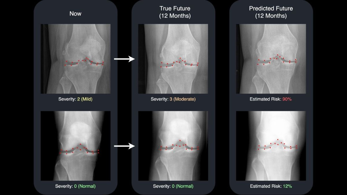 AI predicts future X-rays to help osteoarthritis patients and their doctors  see what's coming | University of Surrey