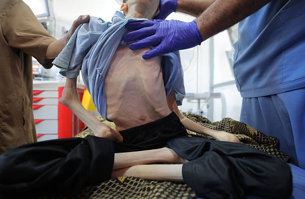 Body of 25-year-old Palestinian Karam Khaled al-Jamal, who lost his life due to malnutrition, is brought to al-Awda Hospital at Nuseirat Camp in Gaza...