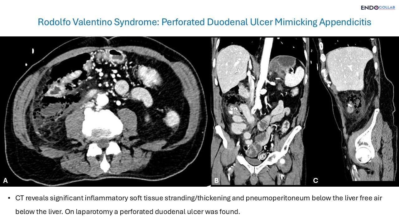 Appendix Alcer Rodolfo Valentino Syndrome: Perforated Duodenal Ulcer Mimicking ...