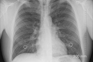Chest Xray